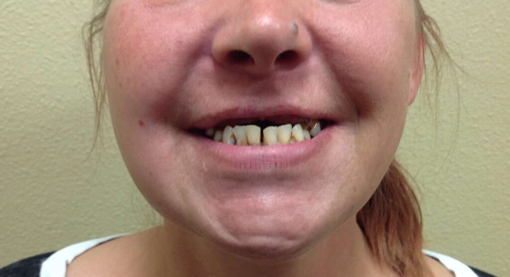 Upper Denture Before